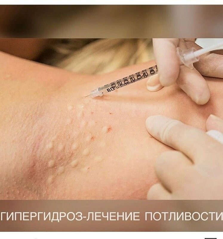 Мезотерапия и Биоревитализация Дермоштамп - Зображення 9